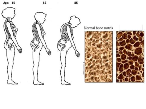 osteoporosis quizlet